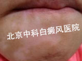 白癜风常识