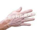 白癜风费用是多少